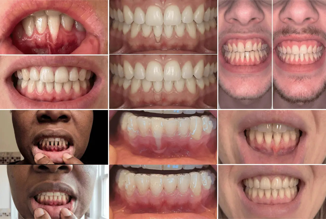 The Real Reason Gum Surgery Costs $4,200 — And the At-Home Technology That Lets You Skip the Bill Entirely