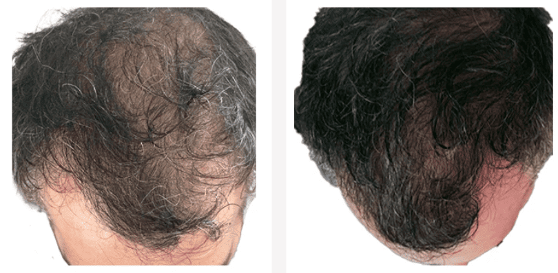 Before and after result