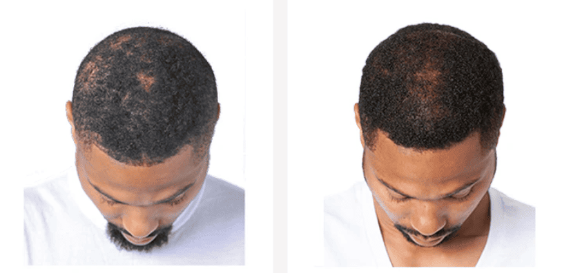 Before and after result
