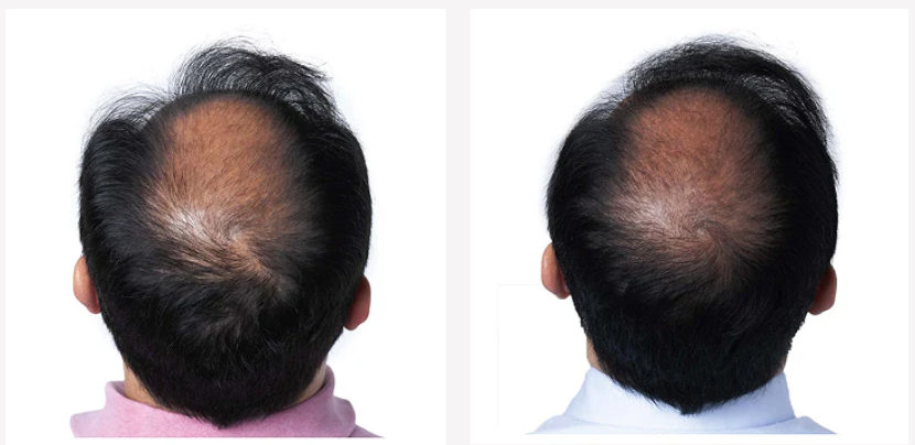 Before and after result