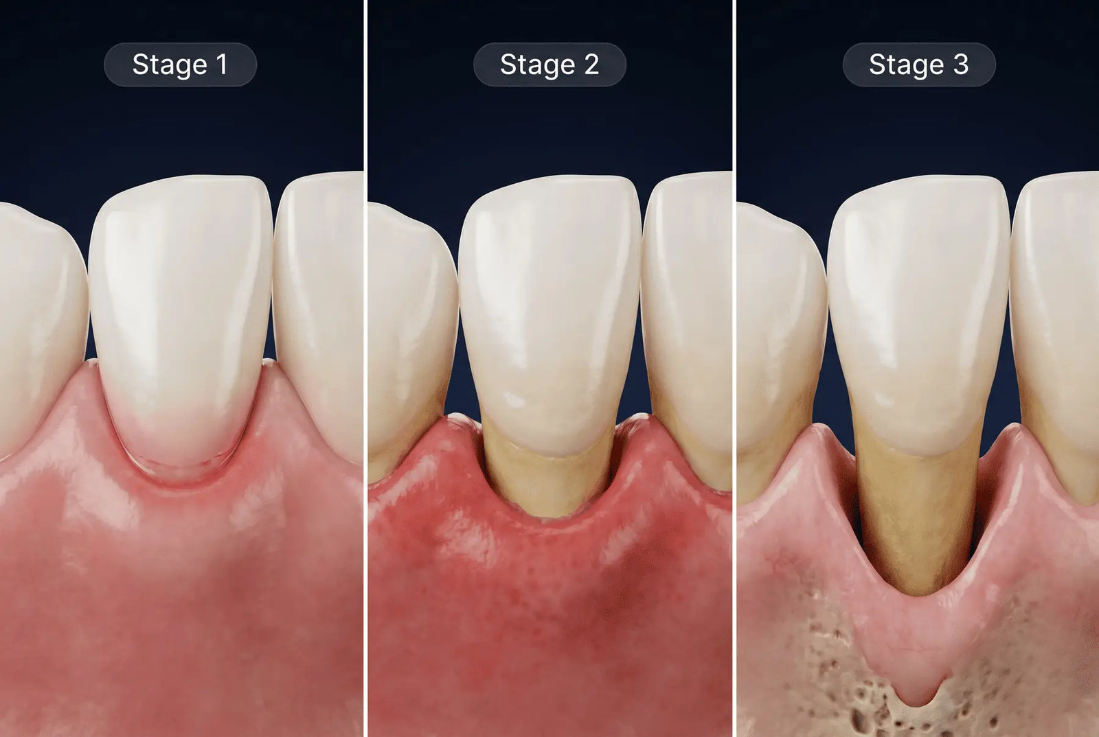 Stage progression
